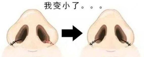 鼻翼缩小