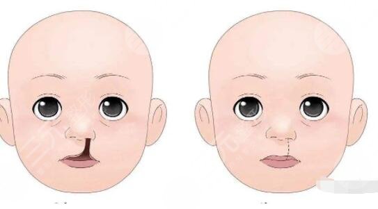 三大知名的唇腭裂专家是谁?