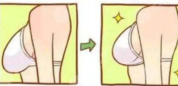 乳房下垂矫正