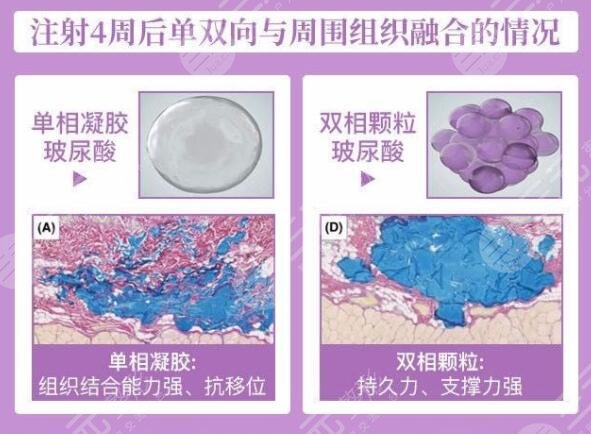 婕尔玻尿酸有后遗症吗？