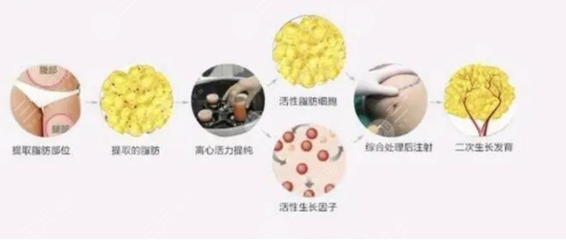 上海刘志欣脂肪填充面部案例