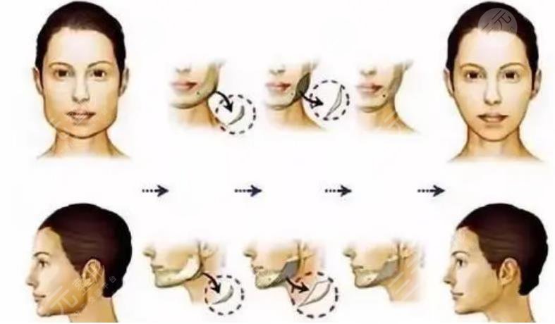 崔荣达医生磨骨案例分享