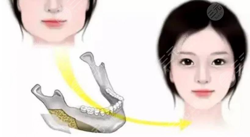 崔荣达医生磨骨案例分享