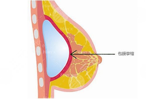青岛曹继武隆胸怎么样？