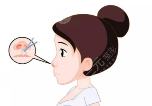 成都周柯做鼻修复案例