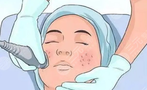 上海马刚医生激光祛斑案例