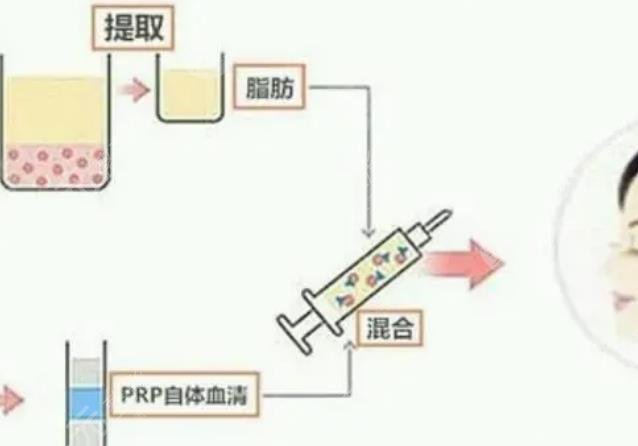 袁玉坤医生自体脂肪移植案例