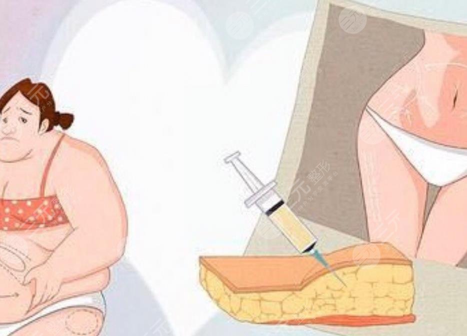 王荣锡医生吸脂案例