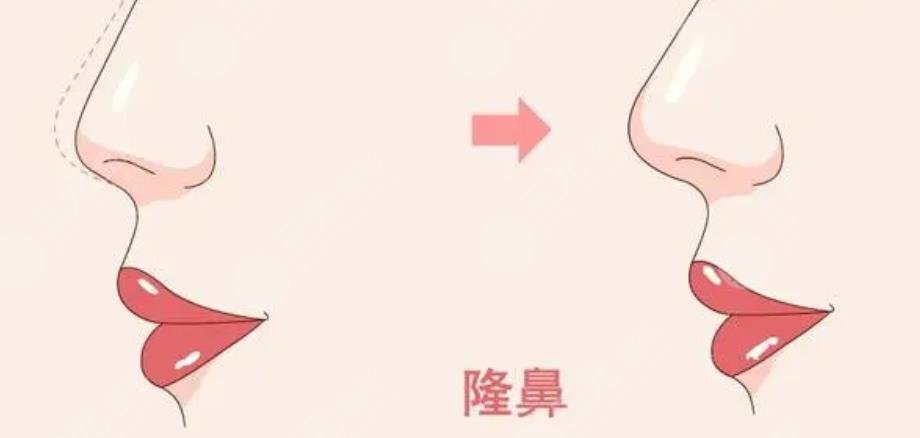 黄惠真医生隆鼻手术案例