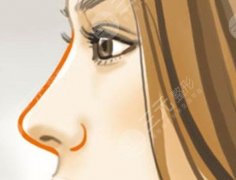 鼻子挛缩的修复方法有哪些?科普解答,手术价格表查询! 鼻子挛缩的修复方法有哪些?科普解答,手术价格表查询!