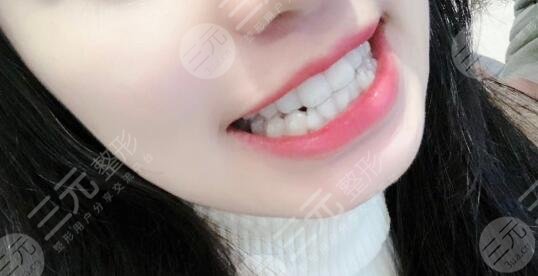 上海第十人民医院牙科隐形矫正案例分享