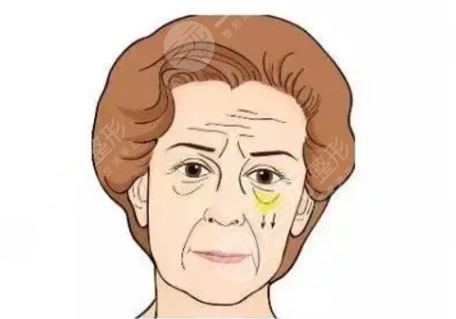上海九院许志成去眼袋怎么样？详情医生案例全过程分享