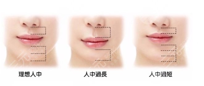 管果医生人中缩短案例