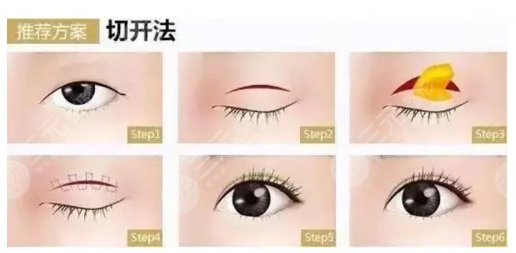 唐鏖医生双眼皮案例