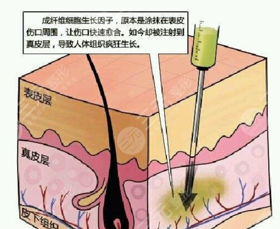 生长因子取出