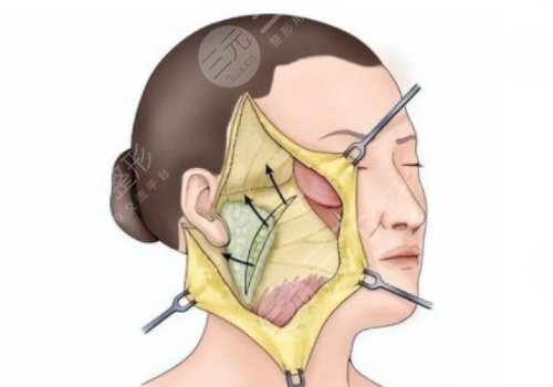 筋膜悬吊提升术能保持多久