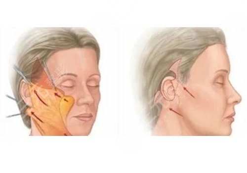 筋膜悬吊提升术能保持多久