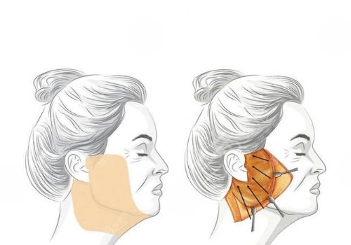 筋膜悬吊面部提升术价格