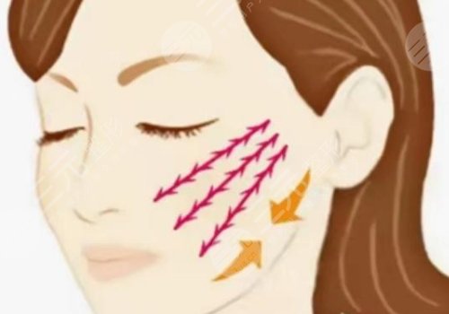 筋膜悬吊面部提升术价格