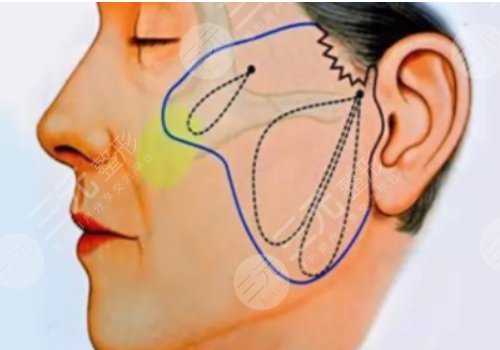 筋膜悬吊面部提升术价格