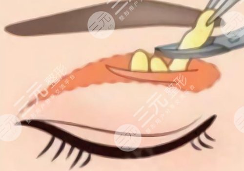 昆明刘哲延眼修复案例图片