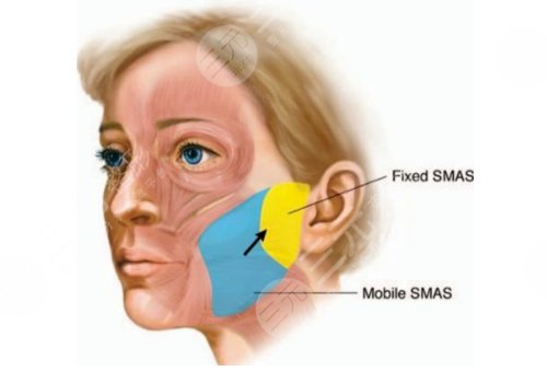 小切口拉皮手术费多少钱