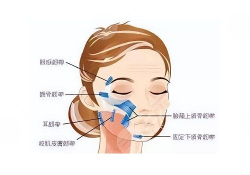 小切口拉皮手术费多少钱