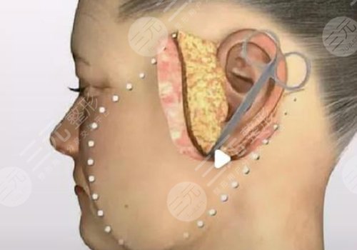 小切口拉皮手术费多少钱