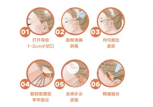 小切口拉皮手术费多少钱