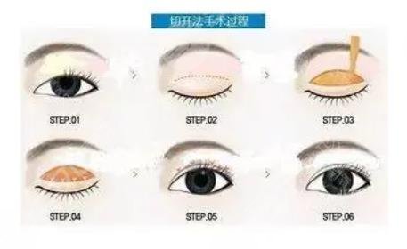 周珍艳医生双眼皮修复案例