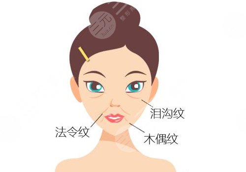 泪沟法令纹怎么改良