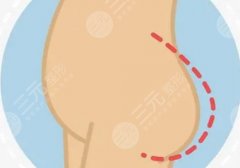 脂肪丰臀多久能恢复好？多久消肿？