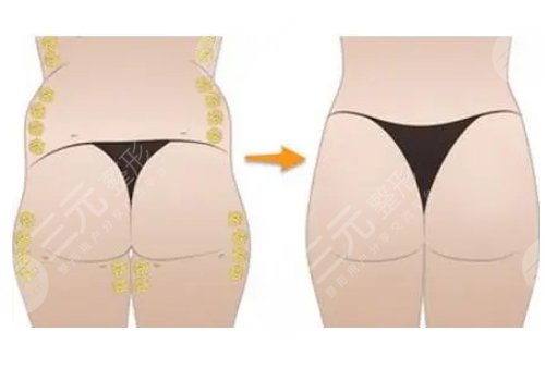 脂肪丰臀多久能恢复好？