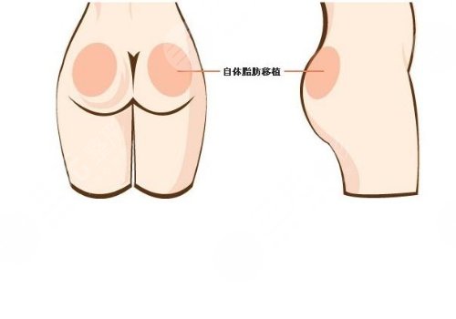 脂肪丰臀多久能恢复好？