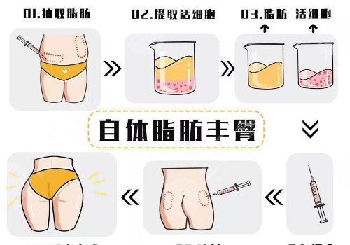 脂肪丰臀多久能恢复好