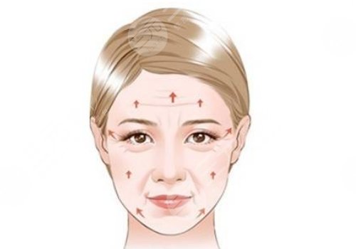 筋膜悬吊面部提升和拉皮的区别