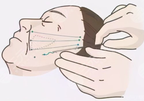 筋膜悬吊面部提升和拉皮的区别