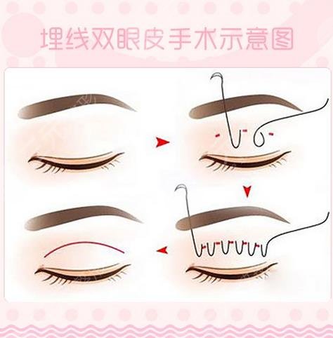 魏国茜双眼皮案例