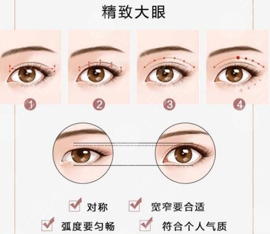 双眼皮