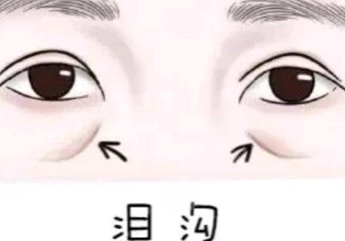 泪沟凹陷怎么解决好？