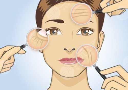 小切口拉皮手术可以维持多久