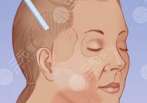 筋膜悬吊术可以维持几年