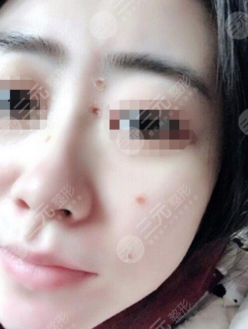 上海第一人民医院美容科点痣案例分享