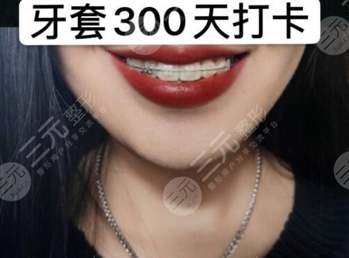 高明区人民医院口腔科牙齿矫正案例真人反馈
