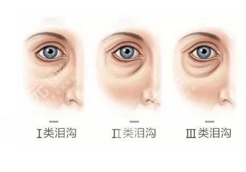 泪沟填充大概要多少钱？