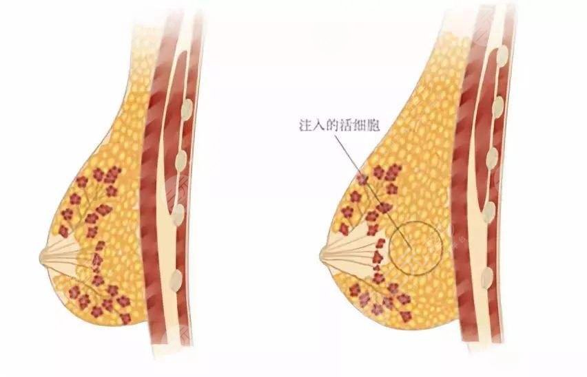 隆胸