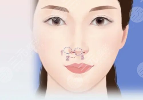 猴化脸鼻基底怎么解决