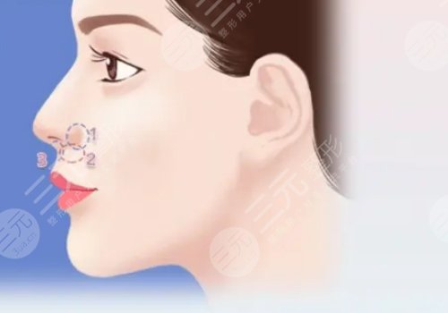 猴化脸鼻基底怎么解决