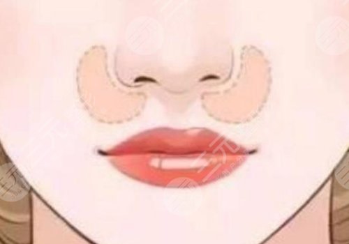 猴化脸鼻基底怎么解决