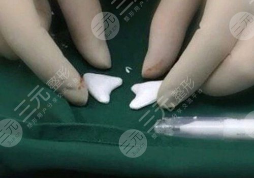 猴化脸鼻基底怎么解决